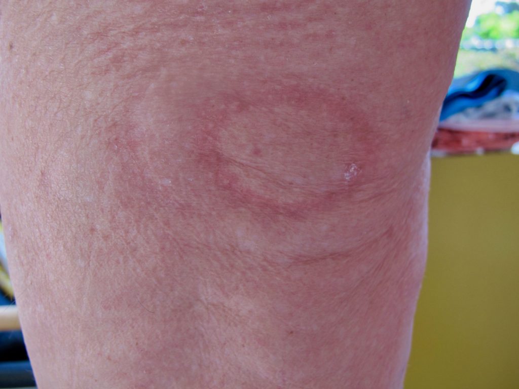 erythema migrans (EM)